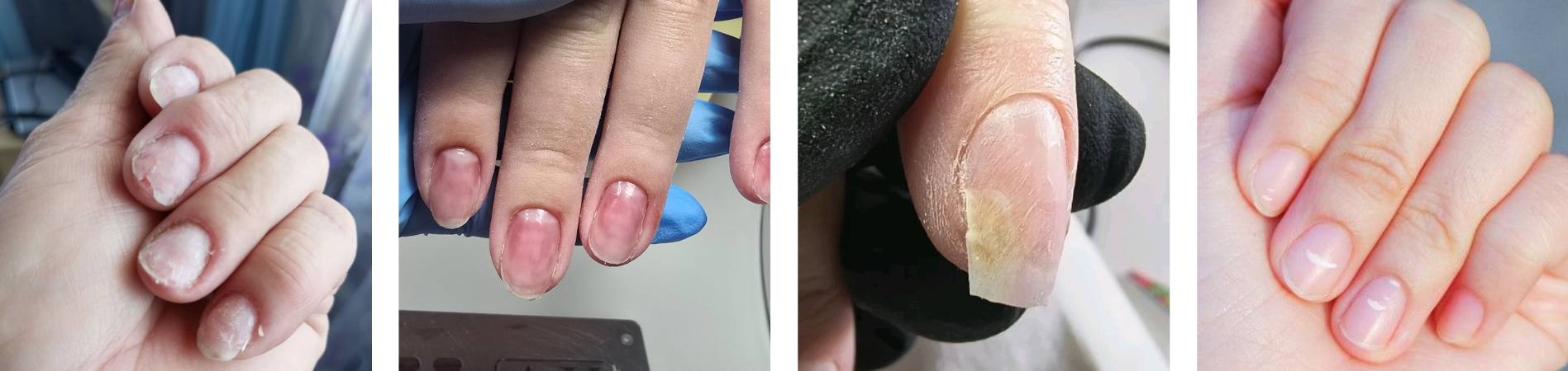 signs of weakened nails
